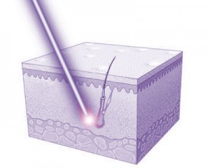 Prstroj na laserov epilciu YILIYA-808CH