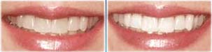 Stav pred a po bielen zubov