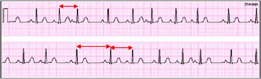 Poruchy EKG Poruchy EKG