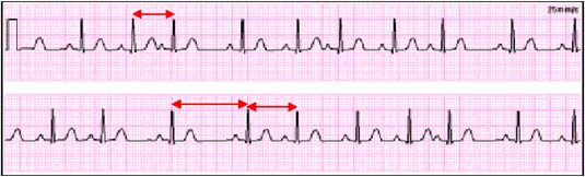 Poruchy EKG