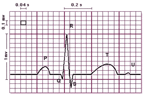 Poruchy EKG