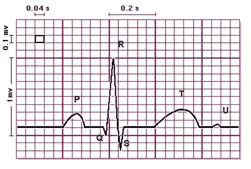 Poruchy EKG Poruchy EKG